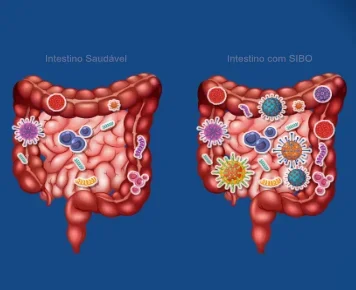 Supercrescimento Bacteriano